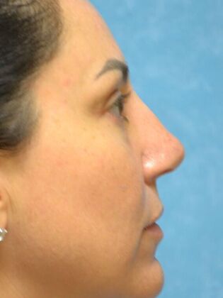 Rhinoplasty: Case 1735- Rossford, OH - After