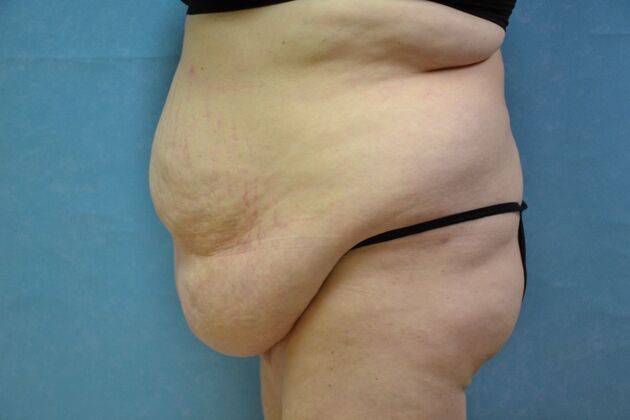 Tummy Tuck: Case 1795- Toledo, OH - Before