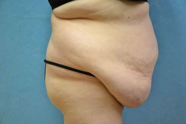 Tummy Tuck: Case 1795- Toledo, OH - Before