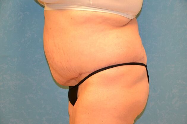 Tummy Tuck: Case 1795- Toledo, OH - After