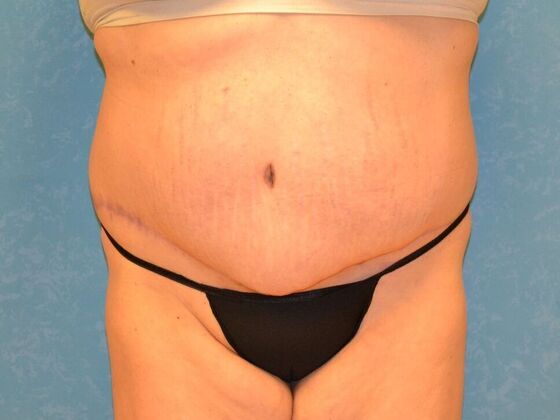 Tummy Tuck Case 1795- Toledo, OH - After