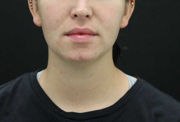 Chin Augmentation: Case 4 - Before