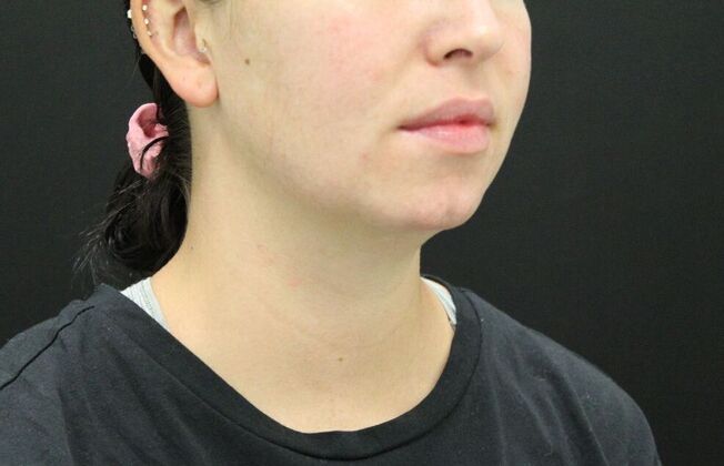 Chin Augmentation: Case 4 - Before