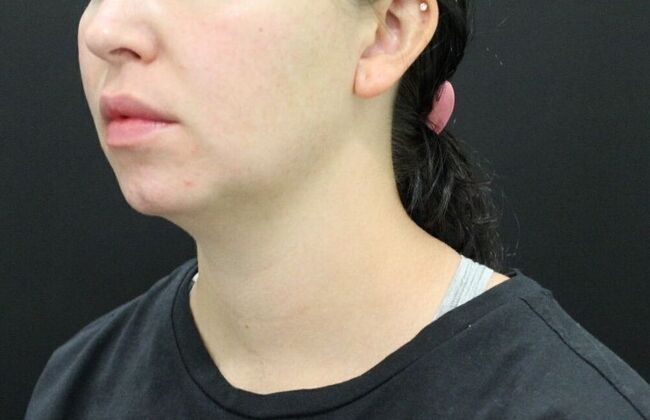 Chin Augmentation: Case 4 - Before