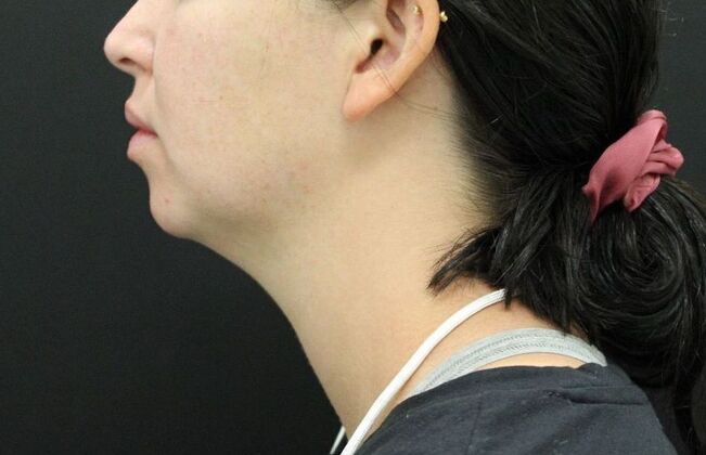 Chin Augmentation: Case 4 - Before