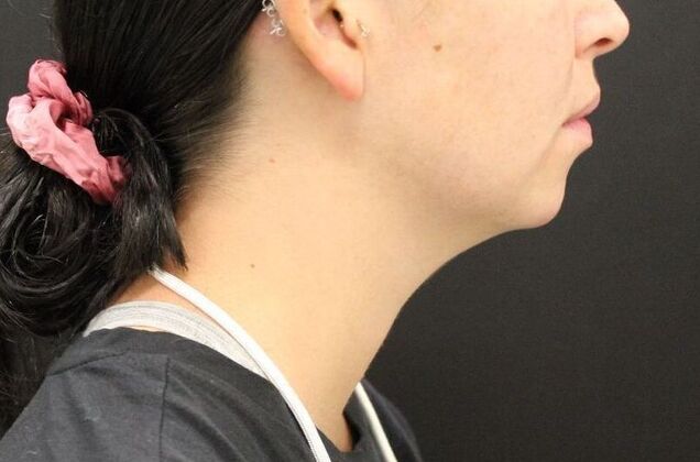 Chin Augmentation: Case 4 - After