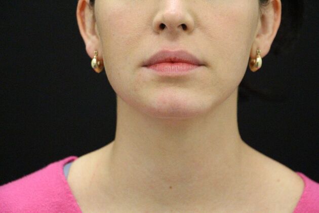 Chin Augmentation: Case 4 - After