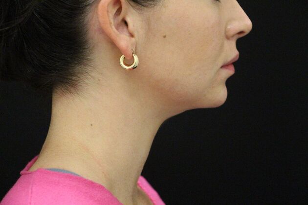 Chin Augmentation: Case 4 - Before