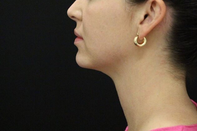 Chin Augmentation: Case 4 - After