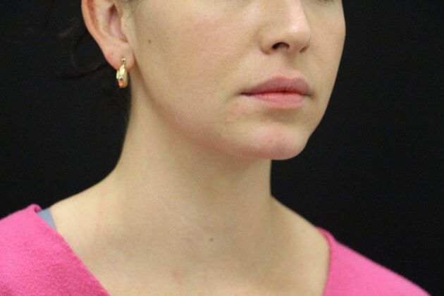 Chin Augmentation: Case 4 - After