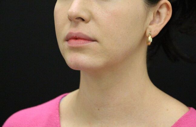 Chin Augmentation: Case 4 - After