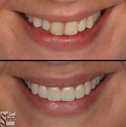 Veneers and Crowns Case 1