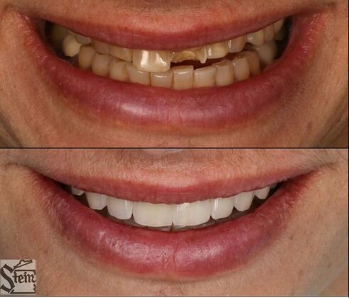 Veneers and Crowns Case 2