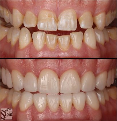 Veneers and Crowns Case 4