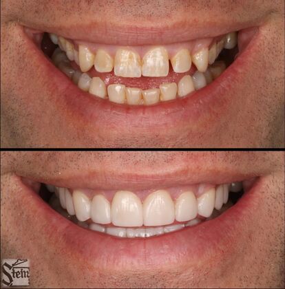 Veneers and Crowns Case 5