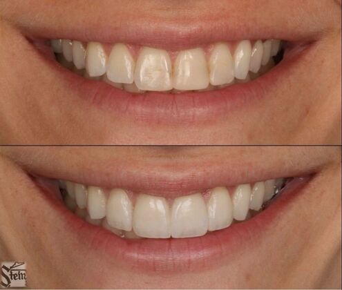 Veneers and Crowns Case 6