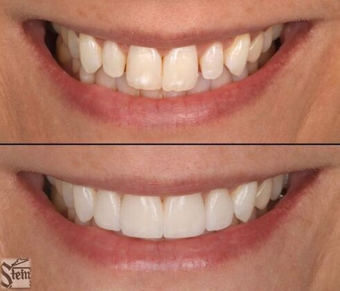 Veneers and Crowns Case 7