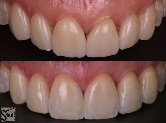 Veneers and Crowns Case 8