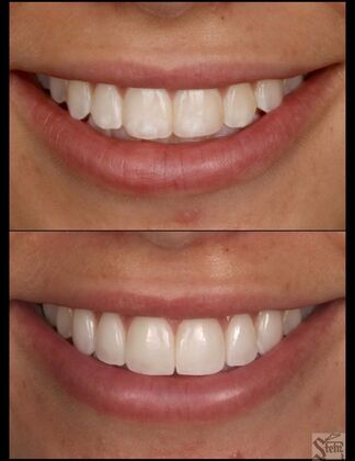 Veneers and Crowns Case 9