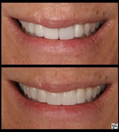Veneers and Crowns Case 10
