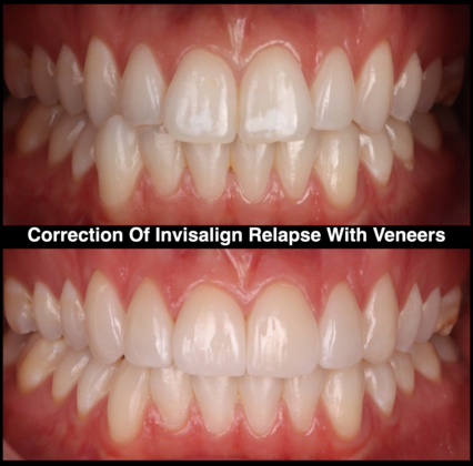 Veneers and Crowns Case 11