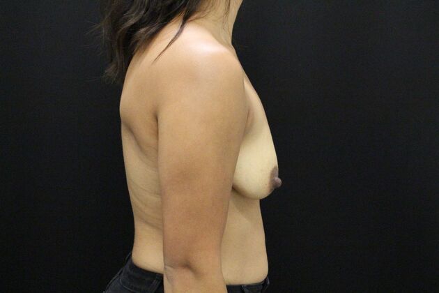 Breast Lift/Breast Lift Augmentation: Case 45 - After
