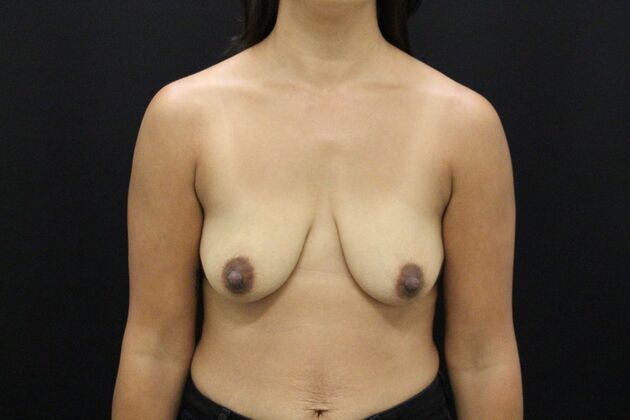 Breast Lift/Breast Lift Augmentation Case 45 - Before