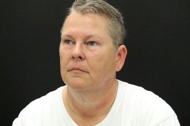 Face & Neck Lifts: Case 26 - Before