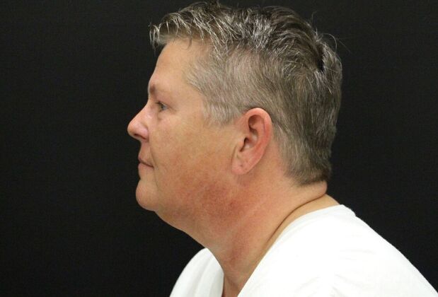 Face & Neck Lifts: Case 26 - Before
