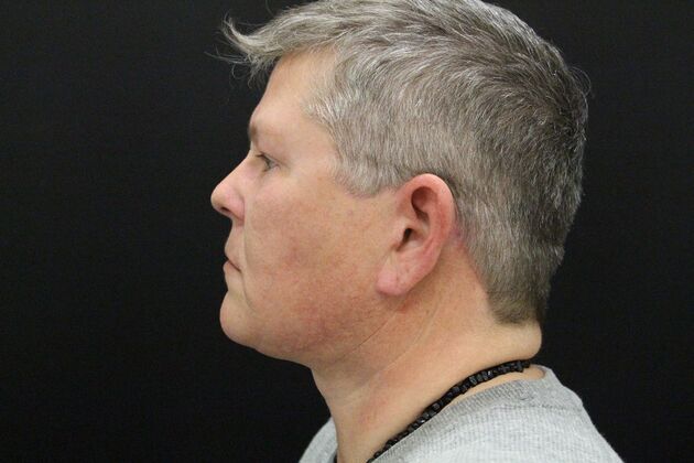 Face & Neck Lifts: Case 26 - After