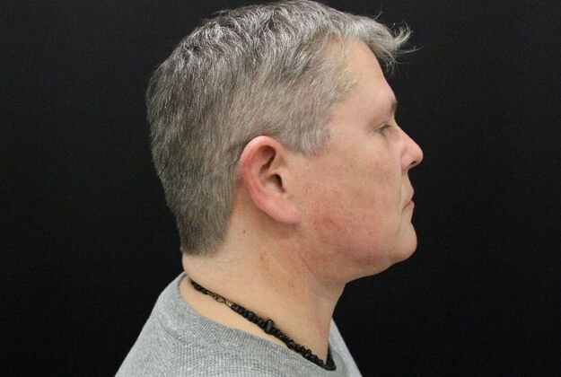 Face & Neck Lifts: Case 26 - After