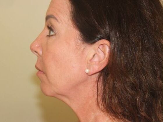 Injectables Case 60 - Before