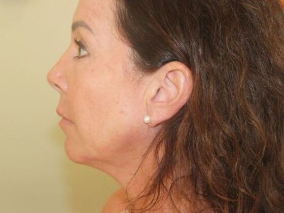 Injectables Case 60 - After