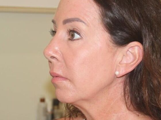 Injectables: Case 60 - Before