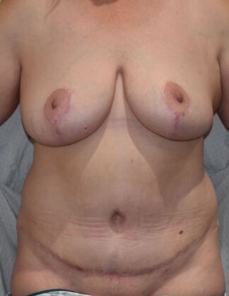 Mommy Makeover Case 279 - After