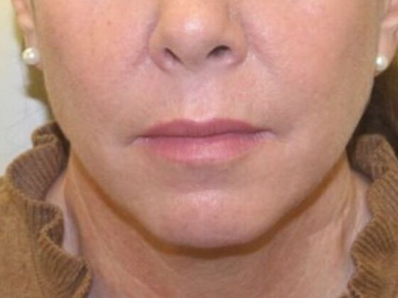 Injectables Case 61 - Before