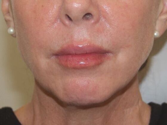 Injectables Case 61 - After