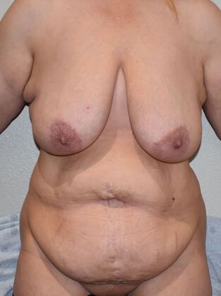Massive Weight Loss  Case 137 - Before