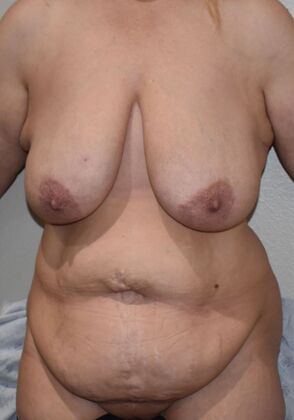 Massive Weight Loss : Case 137 - Before