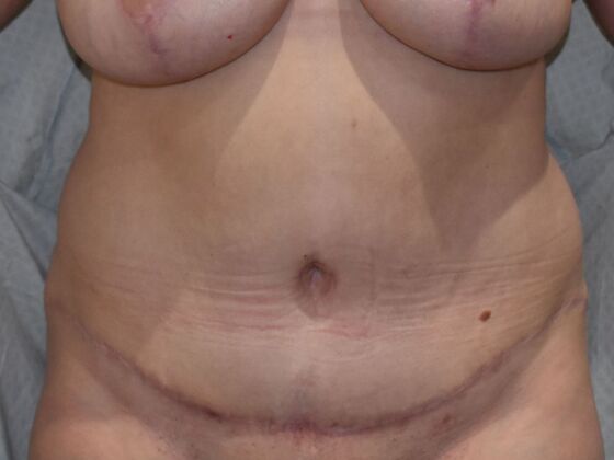 Tummy Tuck (Abdominoplasty): Case 430 - After