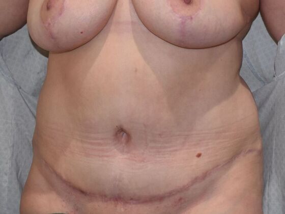 Tummy Tuck (Abdominoplasty): Case 430 - After