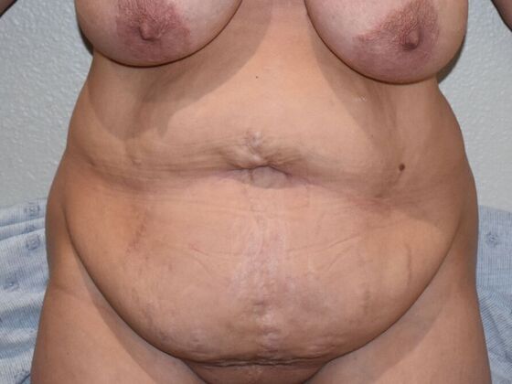 Tummy Tuck (Abdominoplasty): Case 430 - Before