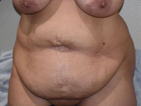 Tummy Tuck (Abdominoplasty): Case 430 - Before