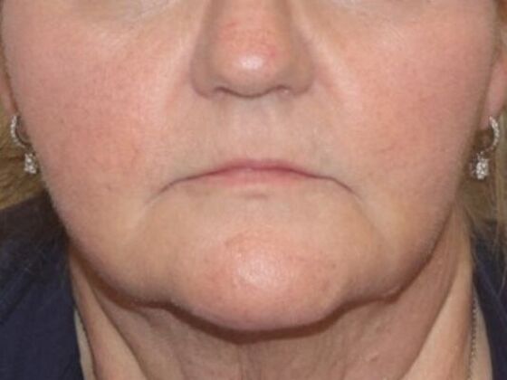 Injectables: Case 62 - Before