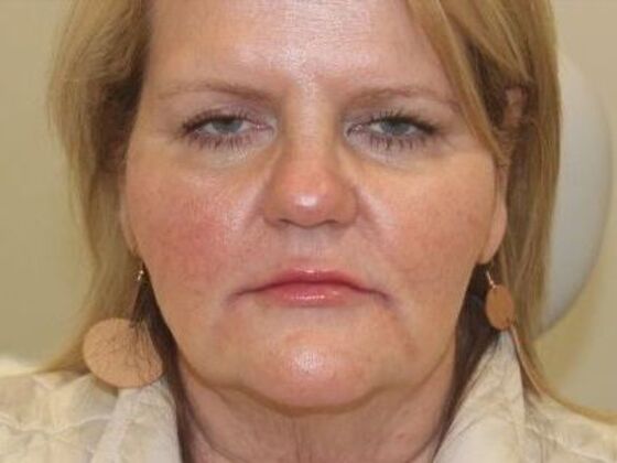 Injectables Case 62 - After