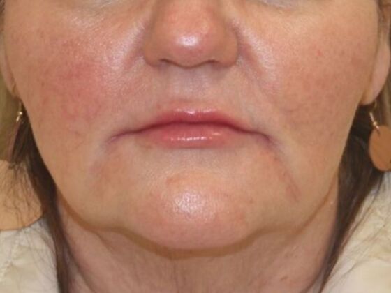 Injectables: Case 62 - After