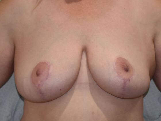Breast Lift (Mastopexy) Case 177 - After