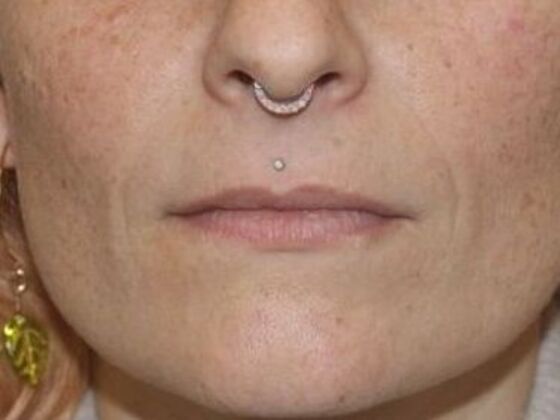 Injectables Case 63 - Before