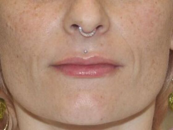 Injectables Case 63 - After