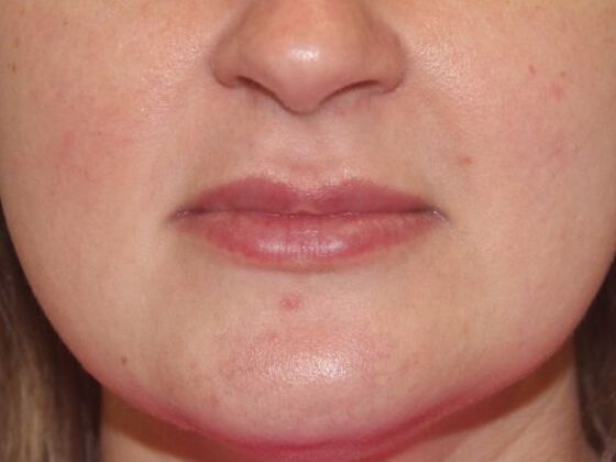 Injectables Case 64 - Before